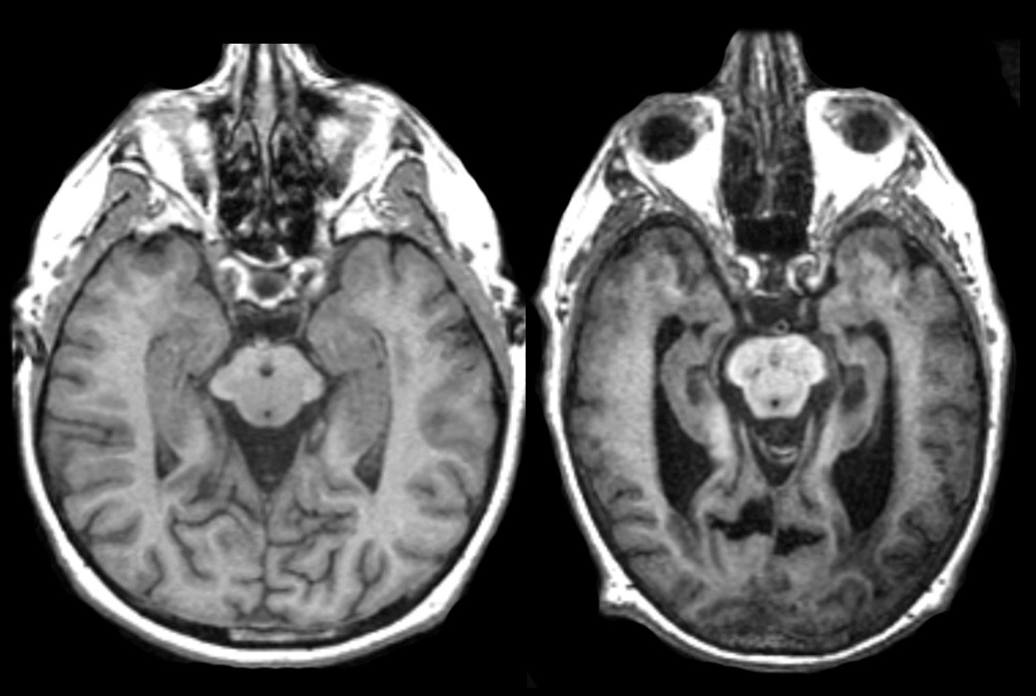 Contaminación aumenta riesgo de padecer Alzheimer